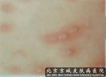 面部带状疱疹的症状 