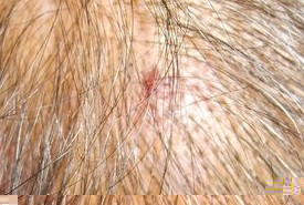 秃发性毛囊炎的防治措施