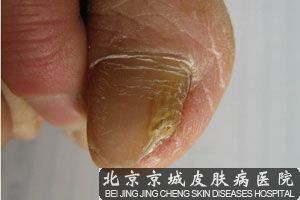 请教医生：灰指甲的症状有哪些