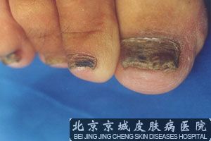引起灰指甲发生的常见原因有哪些