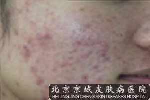 面部易长痤疮的原因有哪些