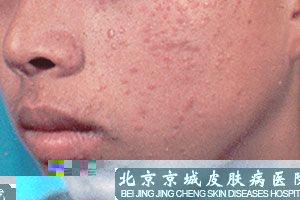扁平疣治疗应注意什么呢 