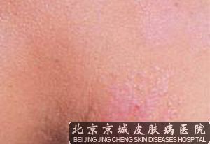 外阴神经性皮炎的鉴别诊断