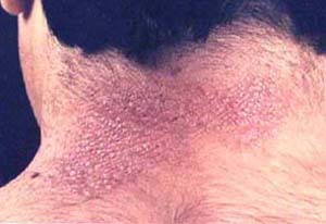 神经性皮炎的饮食原则