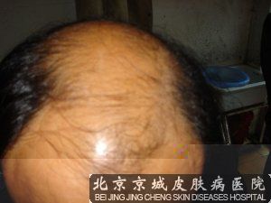 脱发的原因