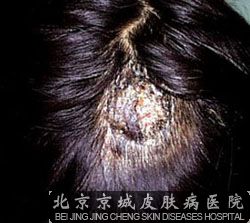 头癣都具有哪些表现