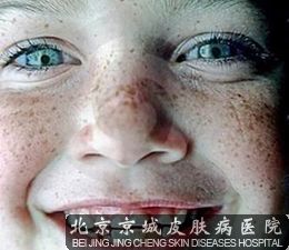 雀斑患者如何祛除脸上的雀斑