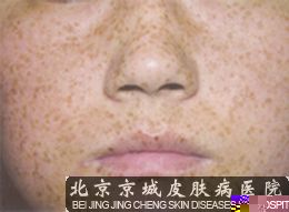 雀斑的原因