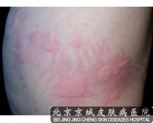 如何护理荨麻疹患儿 
