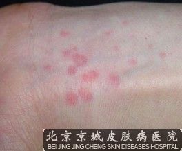 如何治疗人工荨麻疹