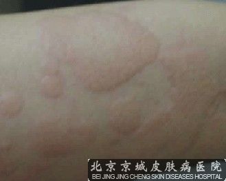荨麻疹患者饮食的注意事项
