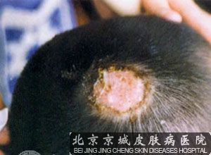 头癣的发病原因 