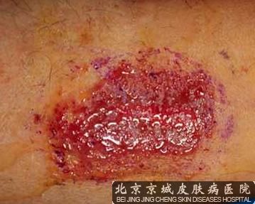 湿疹发病的原因有哪些
