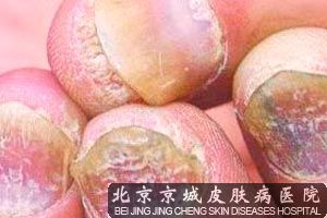 灰指甲症状有哪些