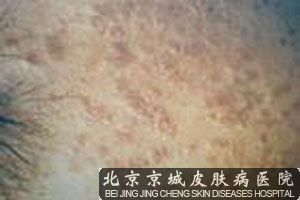 扁平疣患者的主要临床表现介绍