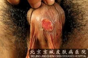 梅毒的症状有哪些 