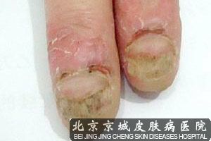 灰指甲是什么症状