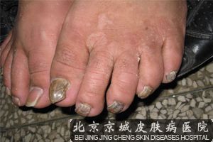 灰指甲的典型症状有哪些