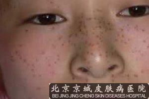 怎样去雀斑*