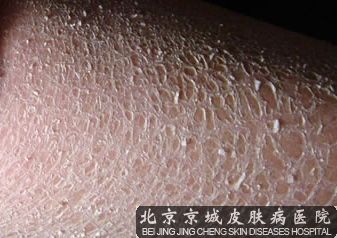 鱼鳞病有什么症状