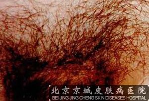 阴虱该如何预防