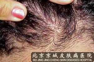 治疗儿童毛囊炎生活中要注意什么