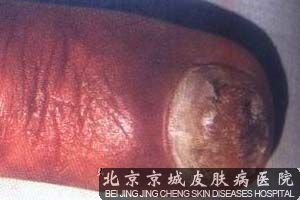 灰指甲的传染会诱发哪些疾病