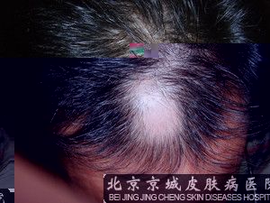 为什么会掉头发