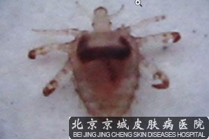 阴虱是什么