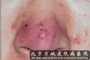 治疗酒糟鼻哪家医院好