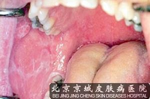 治疗扁平苔癣的方法