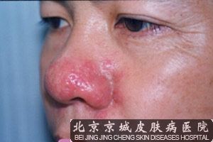 得了酒糟鼻怎么办