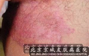 体癣有什么特点