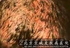 脸部牛皮癣患者的早期症状