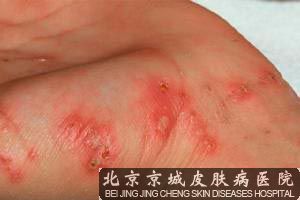 疥疮患者饮食规则