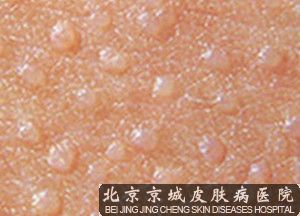 北京哪个医院治疗扁平疣好