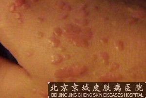 北京哪家医院治疗扁平疣好