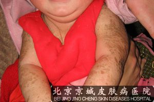 儿童鱼鳞病的病因