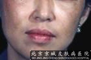 黄褐斑症状需要怎样预防