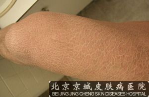 鱼鳞病是什么原因引起的