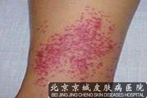 毛囊炎患者的日常饮食护理介绍