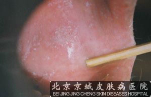 舌扁平苔藓的预防