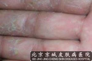 湿疹治疗过程中遇到的3大疑问