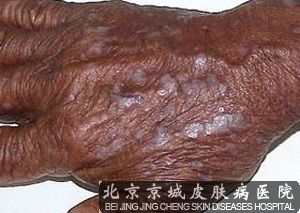 舌扁平苔藓的病发特点及治疗
