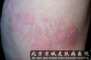 北京荨麻疹*好的治疗方法