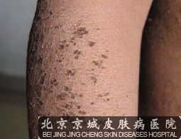 治疗鱼鳞病的医院哪家好