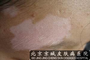 白癜风的治疗误区有哪些