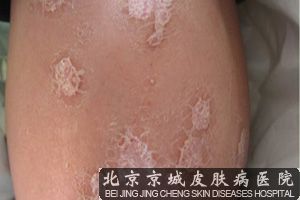 银屑病哪里治疗*好