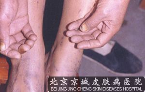 口腔扁平苔藓能 吗