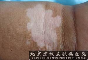 白癜风如何治疗